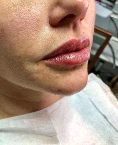 Fotos - Preenchimento Labial antes e depois