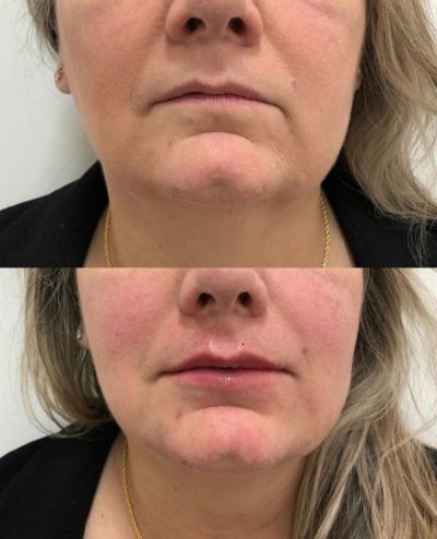 Fotos - Preenchimento Labial antes e depois