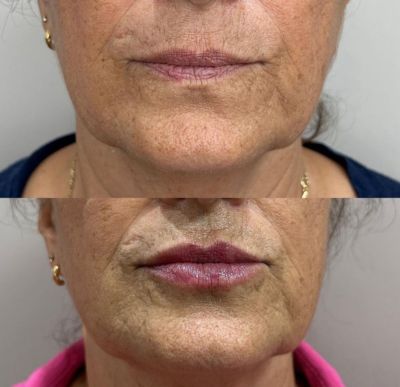Fotos - Preenchimento Labial antes e depois