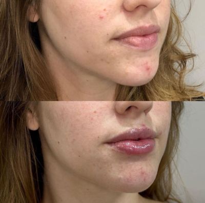 Fotos - Preenchimento Labial antes e depois 4