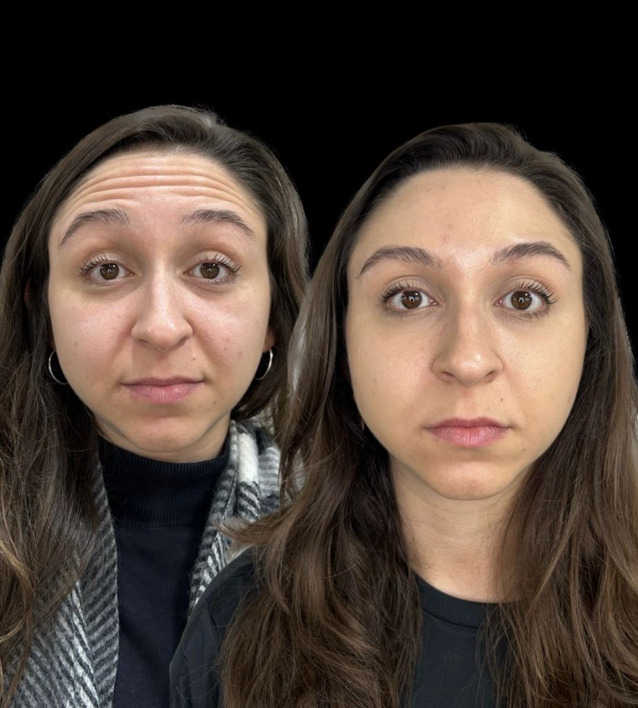 Botox Antes e Depois - Rugas de Expressão