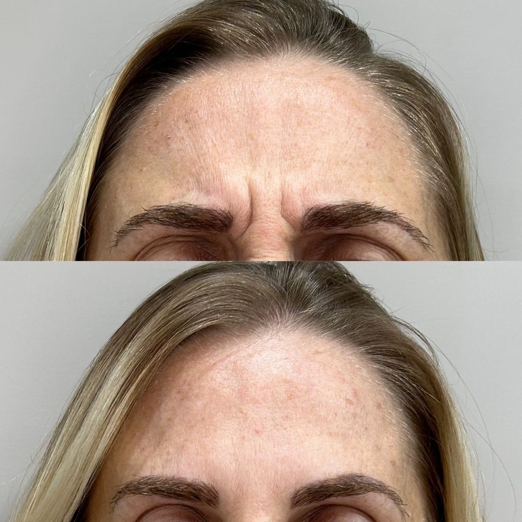 Botox Antes e Depois - Rugas de Expressão
