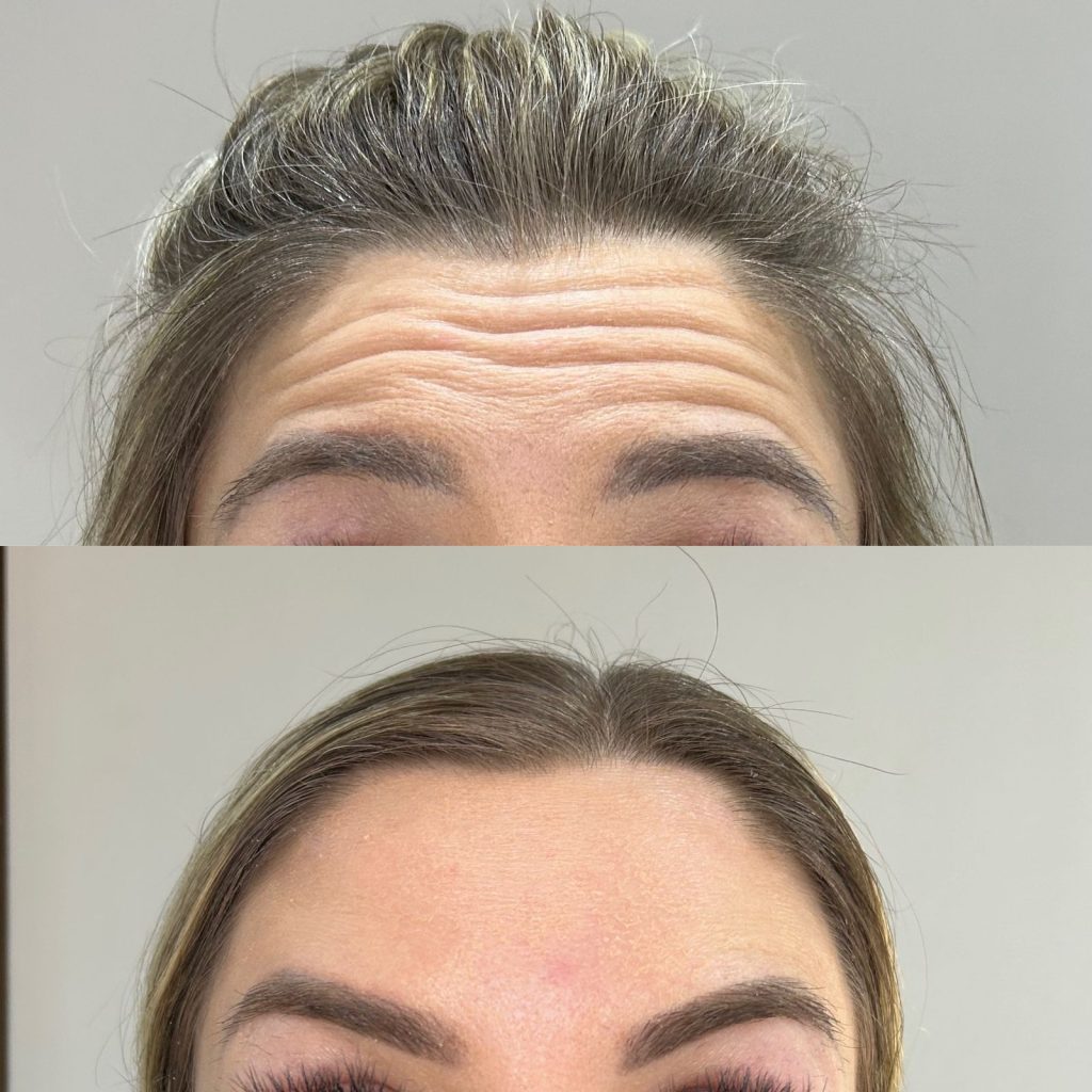 Botox Antes e Depois - Rugas de Expressão