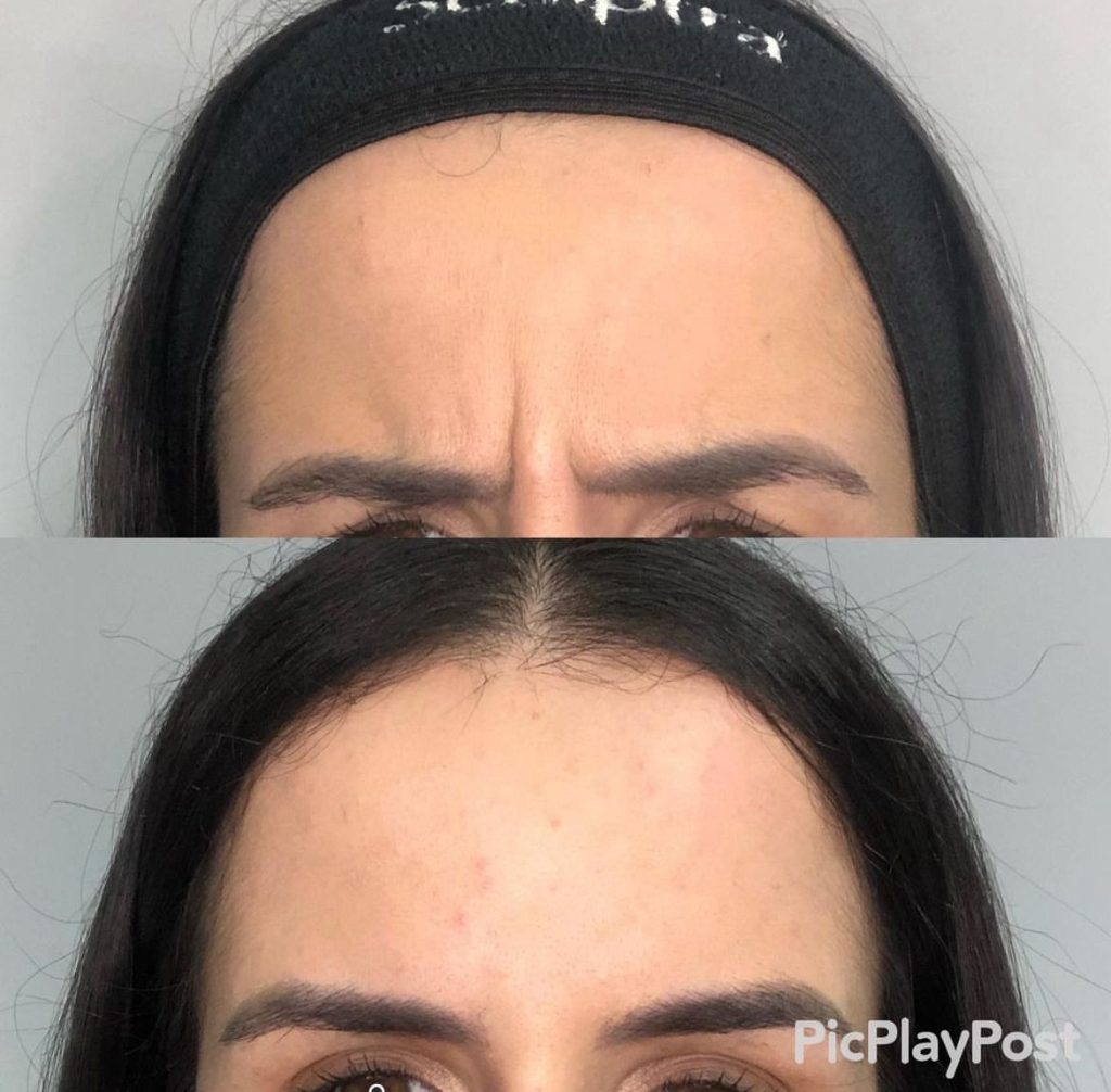 Botox Antes e Depois - Rugas de Expressão