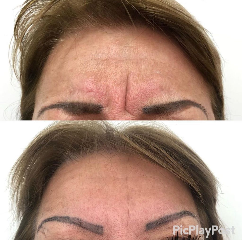Botox Antes e Depois - Rugas de Expressão