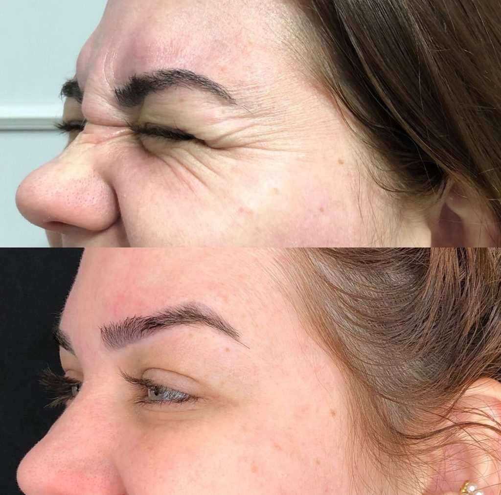 Botox Antes e Depois - Rugas de Expressão