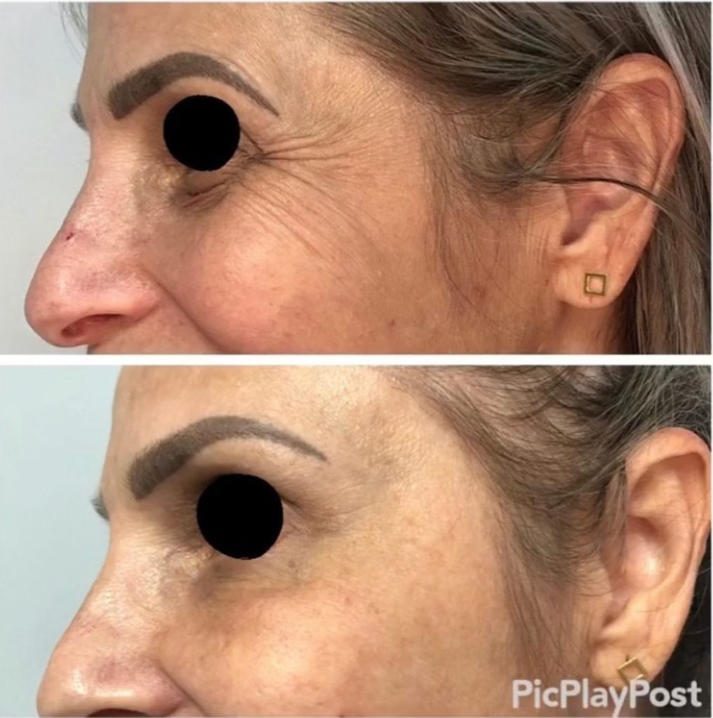 Botox Antes e Depois - Rugas de Expressão
