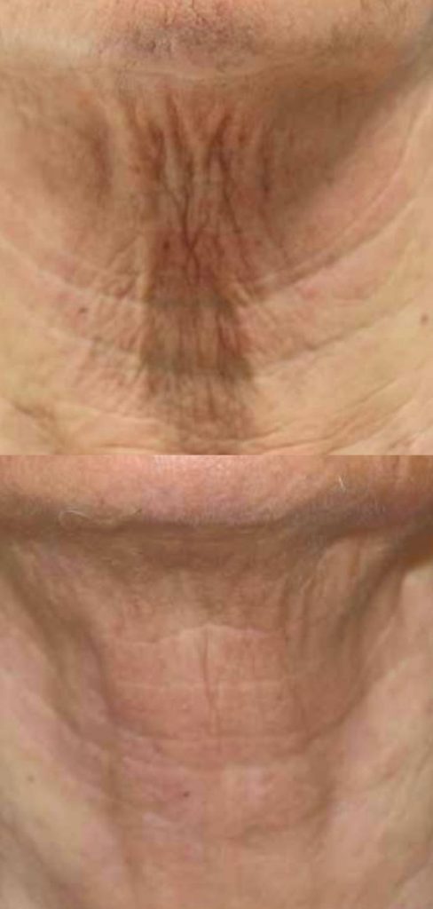 Ultraformer - Antes e Depois