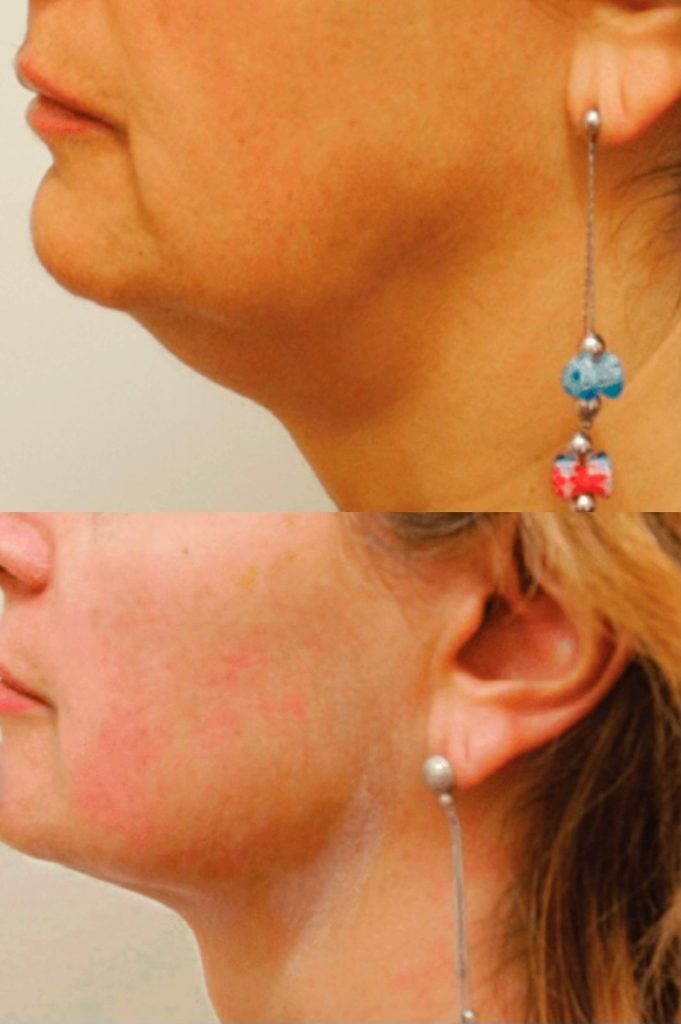 Ultraformer - Antes e Depois