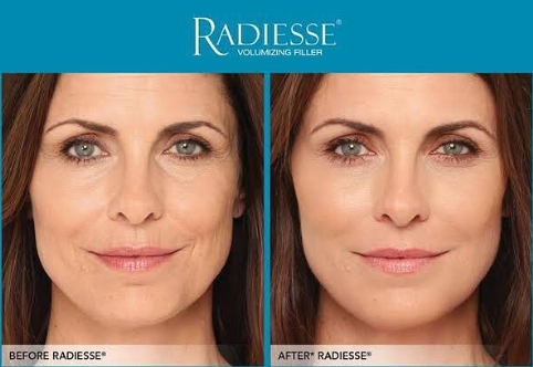 ANTES E DEPOIS RADIESSE Bioestimuladores de Colágeno