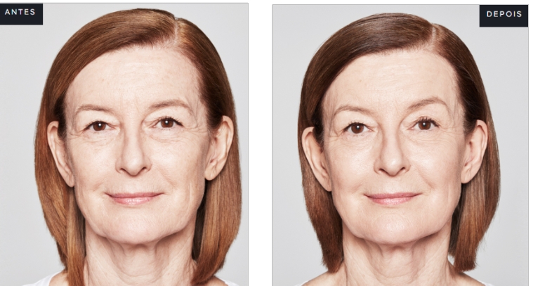 ANTES E DEPOIS SCULPTRA - Bioestimuladores de Colágeno