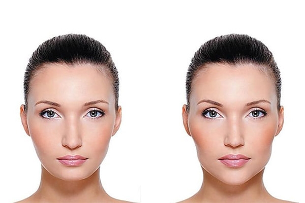 Preenchimento de Mandíbula antes e depois