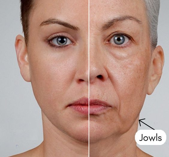 Preenchimento de Mandíbula antes e depois