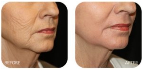 O Que é PDRN e Como Ele Revoluciona os Tratamentos Estéticos? Harmonização Facial